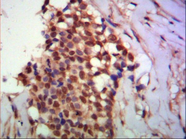 Immunohistochemistry analysis of paraffin-embedded human breast cancer using PPX Monoclonal Antibody