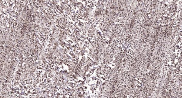 Immunohistochemical analysis of paraffin-embedded human Colon cancer