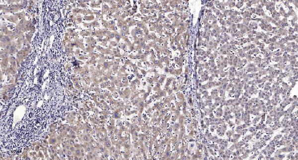 Immunohistochemical analysis of paraffin-embedded human liver cancer