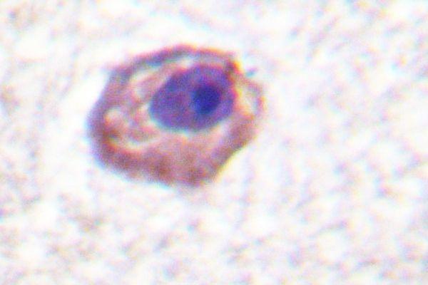 Immunohistochemistry (IHC) analysis of MYL9/MYL12A (P13) pAb in paraffin-embedded human lung carcinoma tissue
