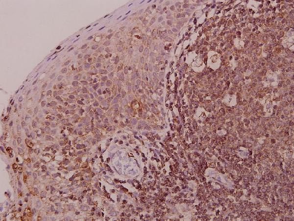 Immunohistochemistry (IHC) analyzes of Myf-6 (R150) pAb in paraffin-embedded human tonsil carcinoma tissue at 1:50