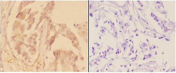 Immunohistochemistry (IHC) analyzes of ADCY 1 (D252) pAb in paraffin-embedded human breast carcinoma tissue at 1:50,showing cytoplasm and membrane staining