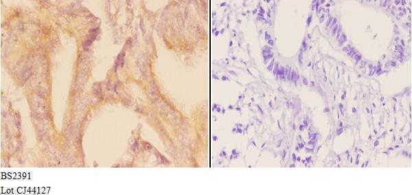 Immunohistochemistry (IHC) analyzes of ADCY 1 (D252) pAb in paraffin-embedded human rectum carcinoma tissue at 1:50,showing cytoplasm and membrane staining