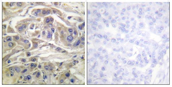 Immunohistochemistry analysis of paraffin-embedded human breast carcinoma, using RapGEF1 Antibody