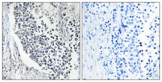 Immunohistochemical analysis of paraffin-embedded Human lung cancer