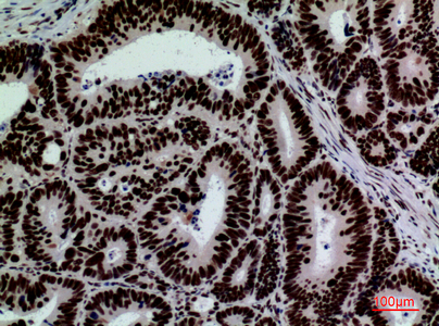 Immunohistochemical analysis of paraffin-embedded human-colon-cancer, antibody was diluted at 1:100