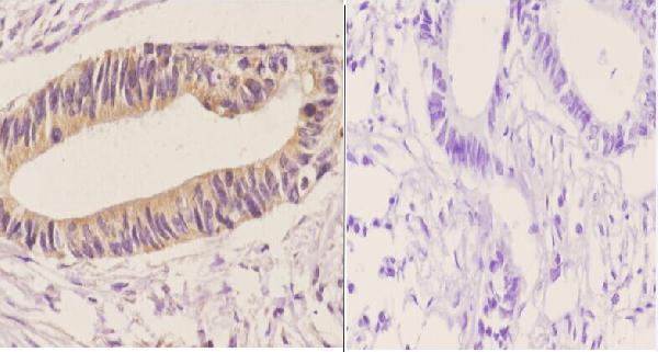 Immunohistochemistry (IHC) analyzes of DGK-ε(S194) pAb in paraffin-embedded human rectum carcinoma tissue at 1:50