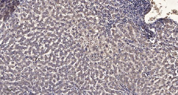 Immunohistochemical analysis of paraffin-embedded human liver cancer
