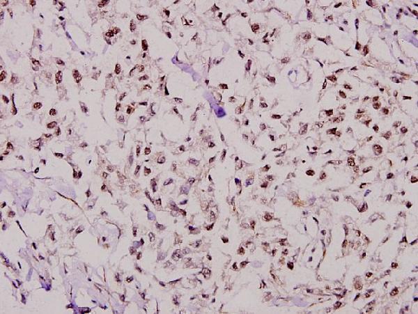 Immunohistochemistry (IHC) analyzes of NF-YB (Q30) pAb in paraffin-embedded human breast carcinoma tissue at 1:100