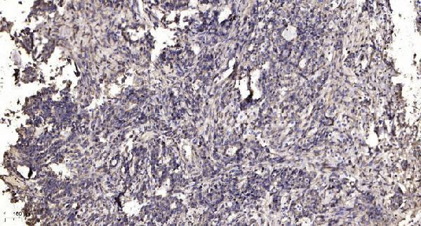 Immunohistochemical analysis of paraffin-embedded human Gastric adenocarcinoma
