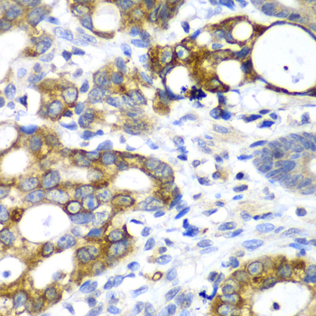 Immunohistochemistry of paraffin-embedded human gastric cancer using AMY2A antibody at dilution of 1:100 (x40 lens)