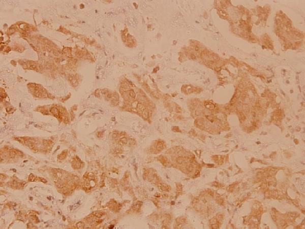 Immunohistochemistry (IHC) analyzes of HLA-DOα (V111) pAb in paraffin-embedded human breast carcinoma tissue at 1:100