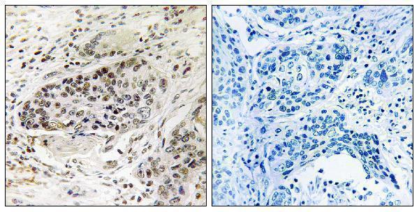 Immunohistochemistry analysis of paraffin-embedded human lung carcinoma tissue, using APBA2 Antibody