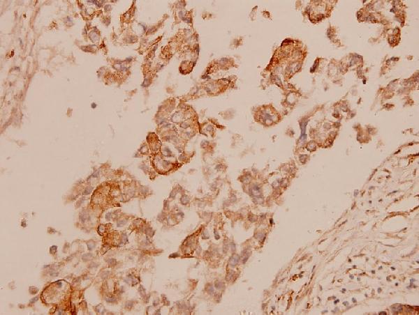 Immunohistochemistry (IHC) analyzes of Cytokeratin 15 (T12) pAb in paraffin-embedded human breast carcinoma tissue at 1:100