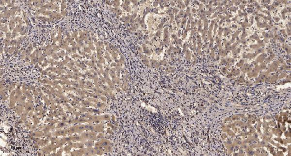 Immunohistochemical analysis of paraffin-embedded human liver cancer