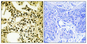 Immunohistochemical analysis of paraffin-embedded Human breast cancer