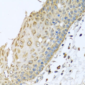 Immunohistochemistry of paraffin-embedded human liver cancer using ARFGAP3 antibody at dilution of 1:100 (x40 lens)