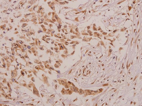 Immunohistochemistry (IHC) analyzes of Defensin α4 (D27) pAb in paraffin-embedded human colorectal carcinoma tissue at 1:50