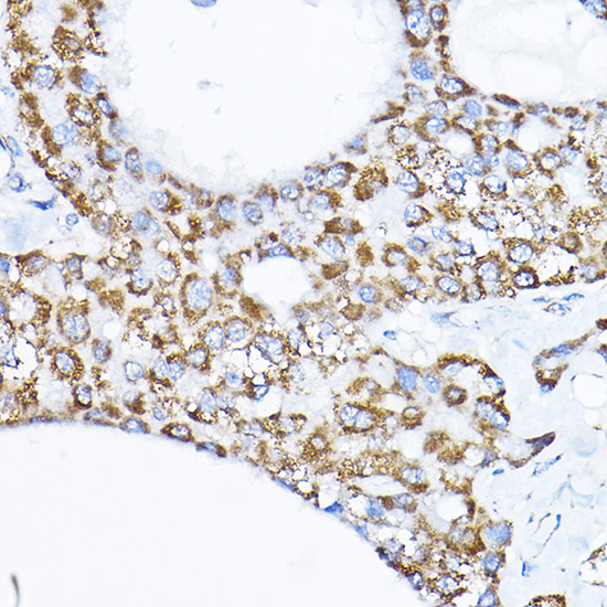 Immunohistochemistry of paraffin-embedded human liver cancer using SAMM50 Rabbit pAb  at dilution of 1:200 