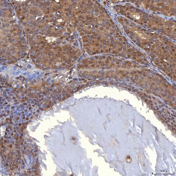  IHC analysis of PIG3/TP53I3 using anti-PIG3/TP53I3 antibody (A06870-3)