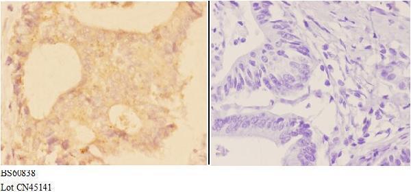 Immunohistochemistry (IHC) analyzes of ADAM28 pAb in paraffin-embedded human colon carcinoma tissue at 1:50,showing membrane and secreted staining