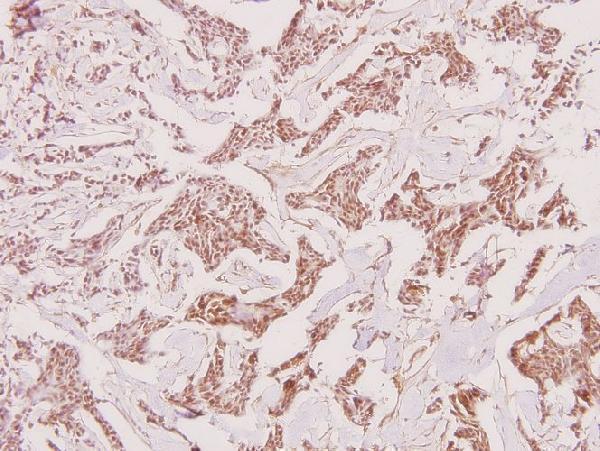 Immunohistochemistry (IHC) analyzes of Recoverin (D143) pAb in paraffin-embedded human breast carcinoma tissue at 1:100