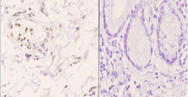 Immunohistochemistry (IHC) analyzes of CSRP1 pAb in paraffin-embedded human esophageal carcinoma tissue at 1:50