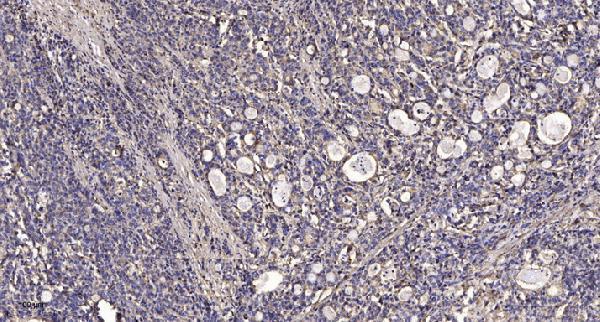 Immunohistochemical analysis of paraffin-embedded human Gastric adenocarcinoma