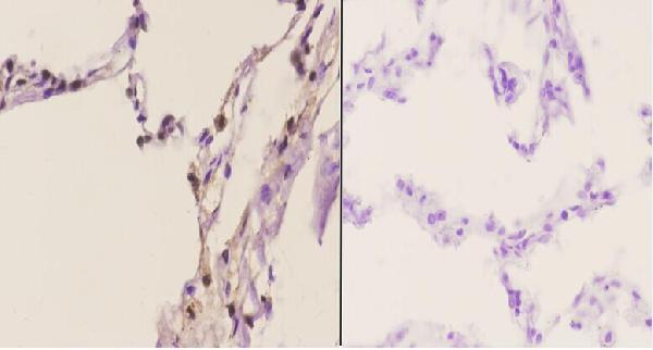 Immunohistochemistry (IHC) analyzes of TRIP13 pAb in paraffin-embedded human lung carcinoma tissue at 1:50