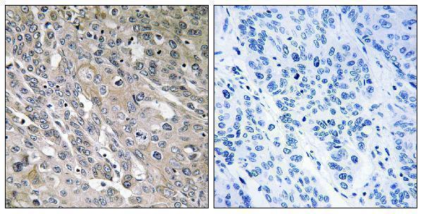Immunohistochemistry analysis of paraffin-embedded human lung carcinoma tissue, using ARHGEF9 Antibody