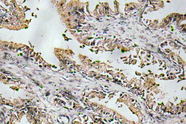 Immunohistochemistry analysis of NT-4 antibody in paraffin-embedded human prostate carcinoma tissue