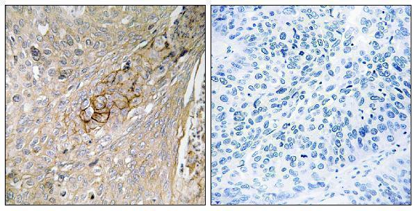 Immunohistochemistry analysis of paraffin-embedded human lung carcinoma tissue, using SLC6A6 Antibody