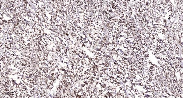 Immunohistochemical analysis of paraffin-embedded human Colon cancer
