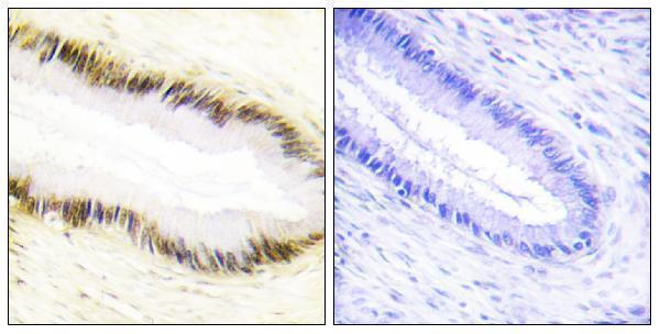 Immunohistochemistry analysis of paraffin-embedded human cervix carcinoma tissue, using NR2F6 Antibody