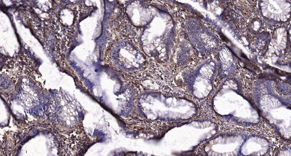 Immunohistochemical analysis of paraffin-embedded human colon cancer