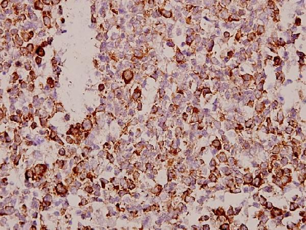 Immunohistochemistry (IHC) analyzes of Tetraspanin-8 (S129) pAb in paraffin-embedded human tonsil carcinoma tissue at 1:50