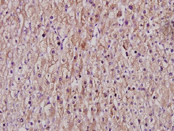 Immunohistochemistry (IHC) analyzes of CYP2C8/9/18/19 (M136) pAb in paraffin-embedded liver cancer tissue at 1:100