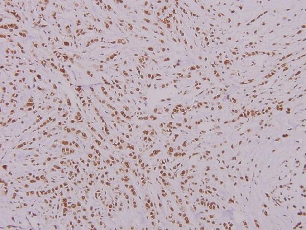 Immunohistochemistry (IHC) analyzes of FoxK1 (G698) pAb in paraffin-embedded human breast carcinoma tissue at 1:100