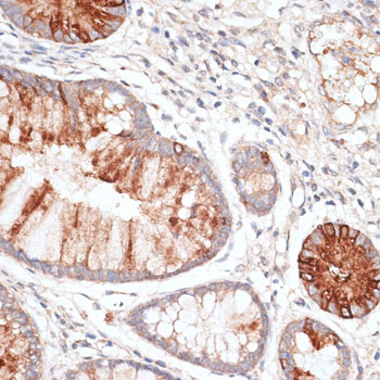 Immunohistochemistry of paraffin-embedded human colon carcinoma using KIR3DL3 antibody  at dilution of 1:100 