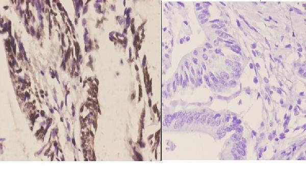 Immunohistochemistry (IHC) analyzes of CstF-64 (R46) pAb in paraffin-embedded human colon carcinoma tissue at 1:50