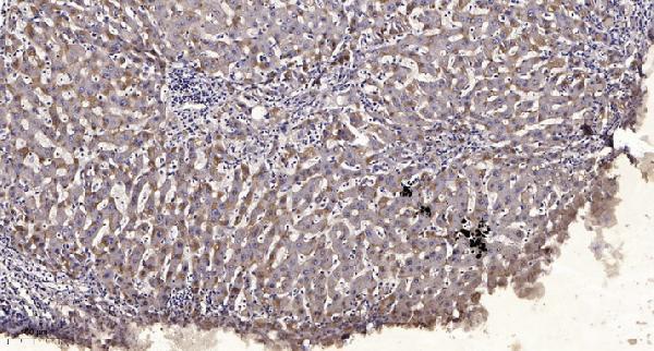 Immunohistochemical analysis of paraffin-embedded human liver cancer