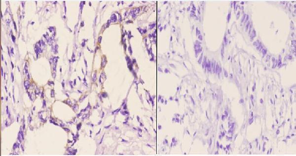 Immunohistochemistry (IHC) analyzes of Rho H (M134) pAb in paraffin-embedded human rectum carcinoma tissue at 1:50