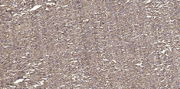 Immunohistochemical analysis of paraffin-embedded human small intestinal carcinoma tissue