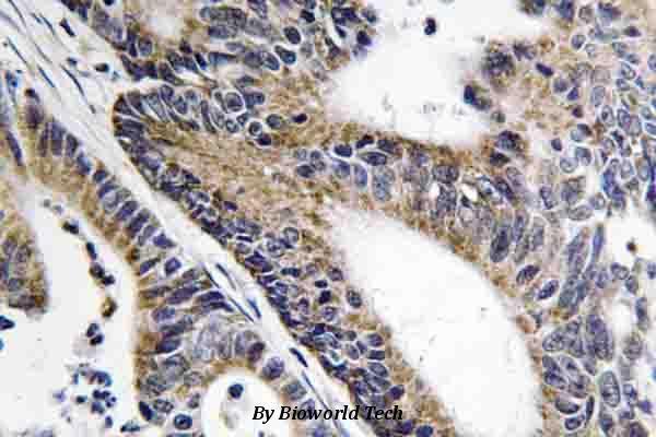 Immunohistochemistry (IHC) analyzes of Nephrocystin-5 (R467) pAb in paraffin-embedded human colon carcinoma tissue
