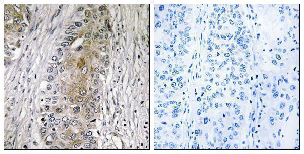 Immunohistochemistry analysis of paraffin-embedded human lung carcinoma, using SAA4 Antibody