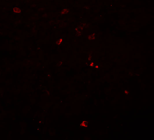 Immunofluorescence of BCAS3 in human breast carcinoma tissue with BCAS3 antibody at 20 μg/mL