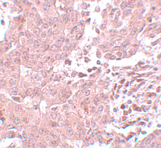 Immunohistochemistry of BCAS3 in human breast carcinoma with BCAS3 antibody at 5 μg/mL