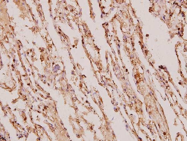 Immunohistochemistry (IHC) analyzes of TIMP-4 (S206) pAb in paraffin-embedded human lung carcinoma tissue at 1:100