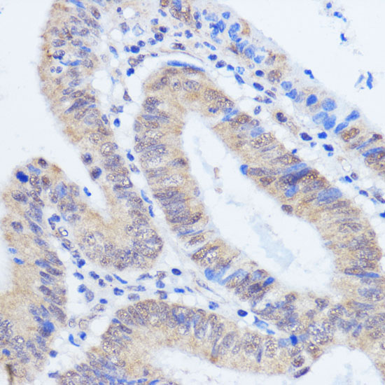 Immunohistochemistry of paraffin-embedded human colon carcinoma using RBM39 antibody  at dilution of 1:100 