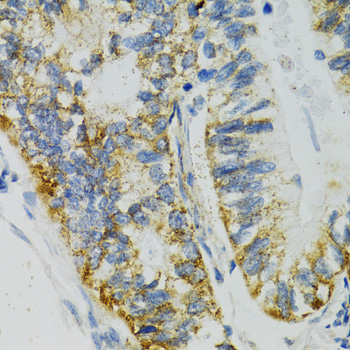 Immunohistochemistry of paraffin-embedded human gastric cancer using SLC27A2 antibody  at dilution of 1:100 